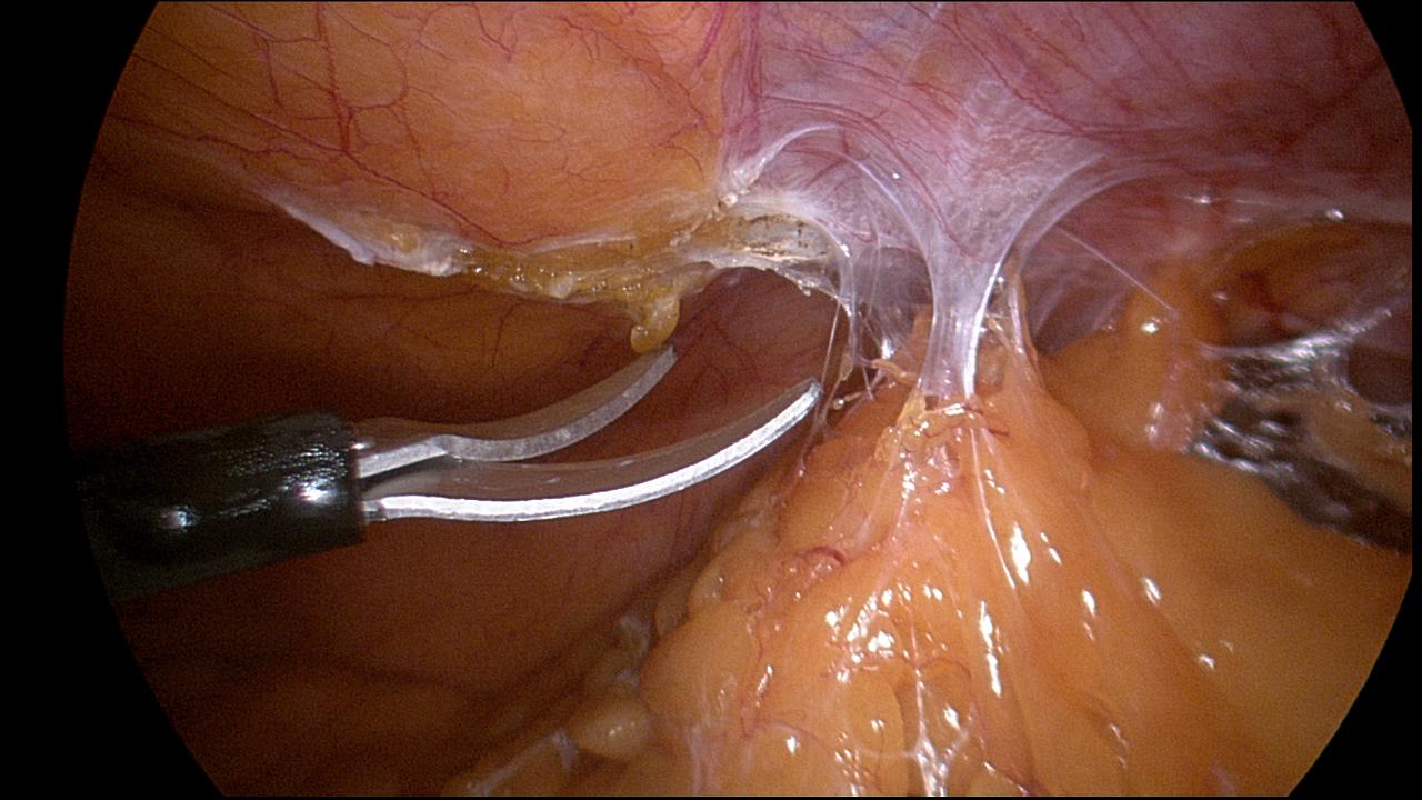 Omental Adhesiolysis HT3 Omental Adhesiolysis HT3